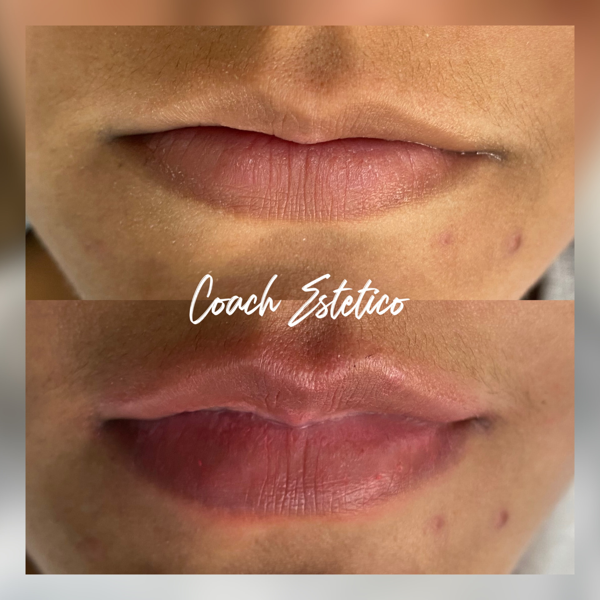 Antes y después: HidraGloss labial con Dermapen