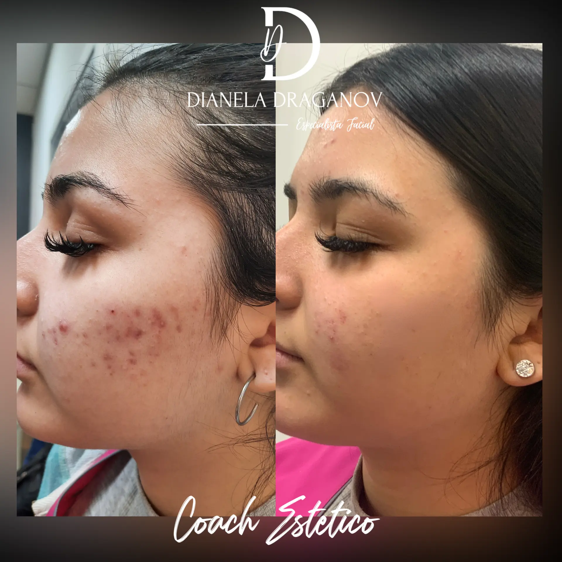 Antes y después: Acné y marcas post inflamatorias