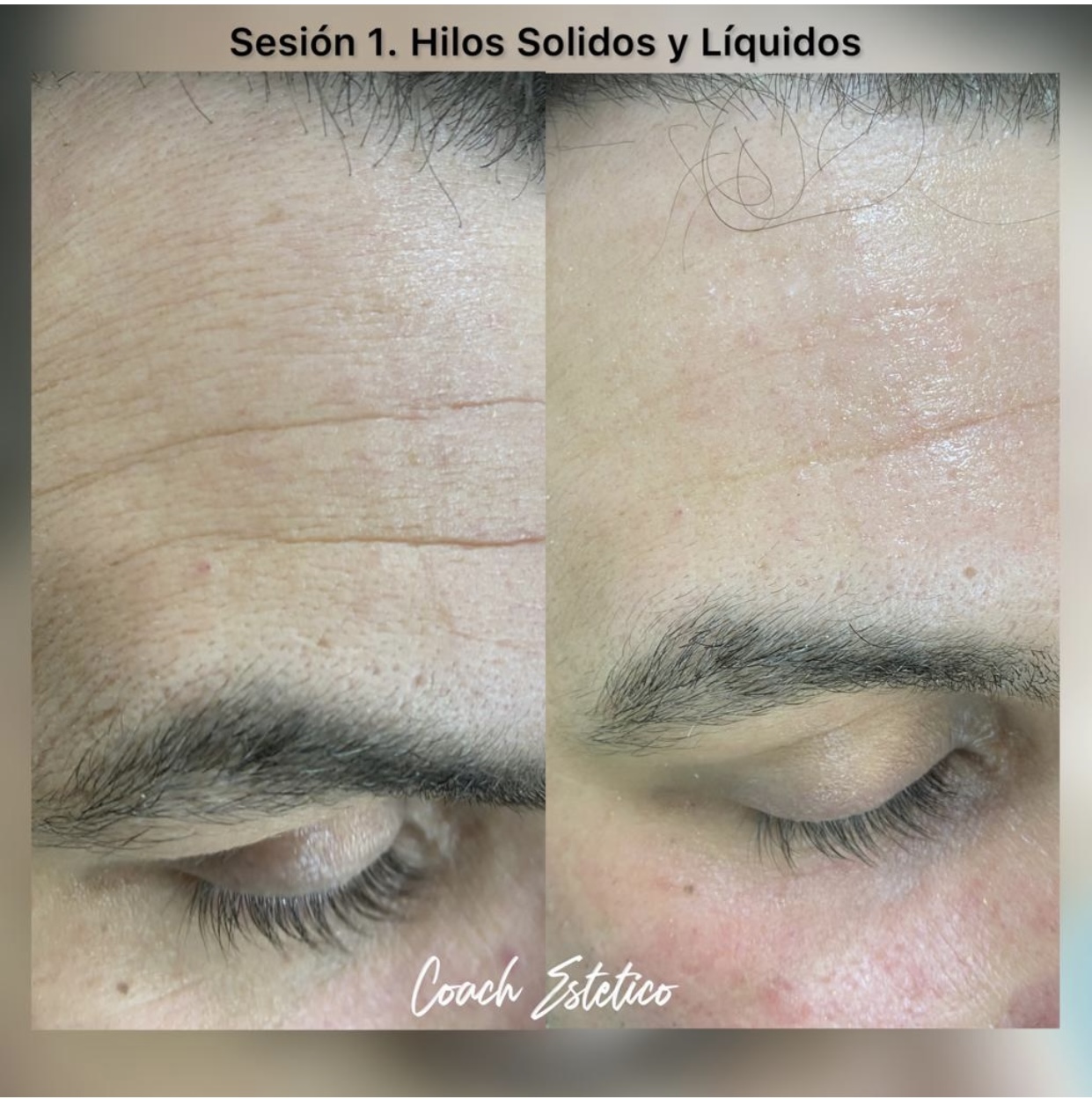 Antes y después: Hilos líquidos y sólidos: entrecejo y frente