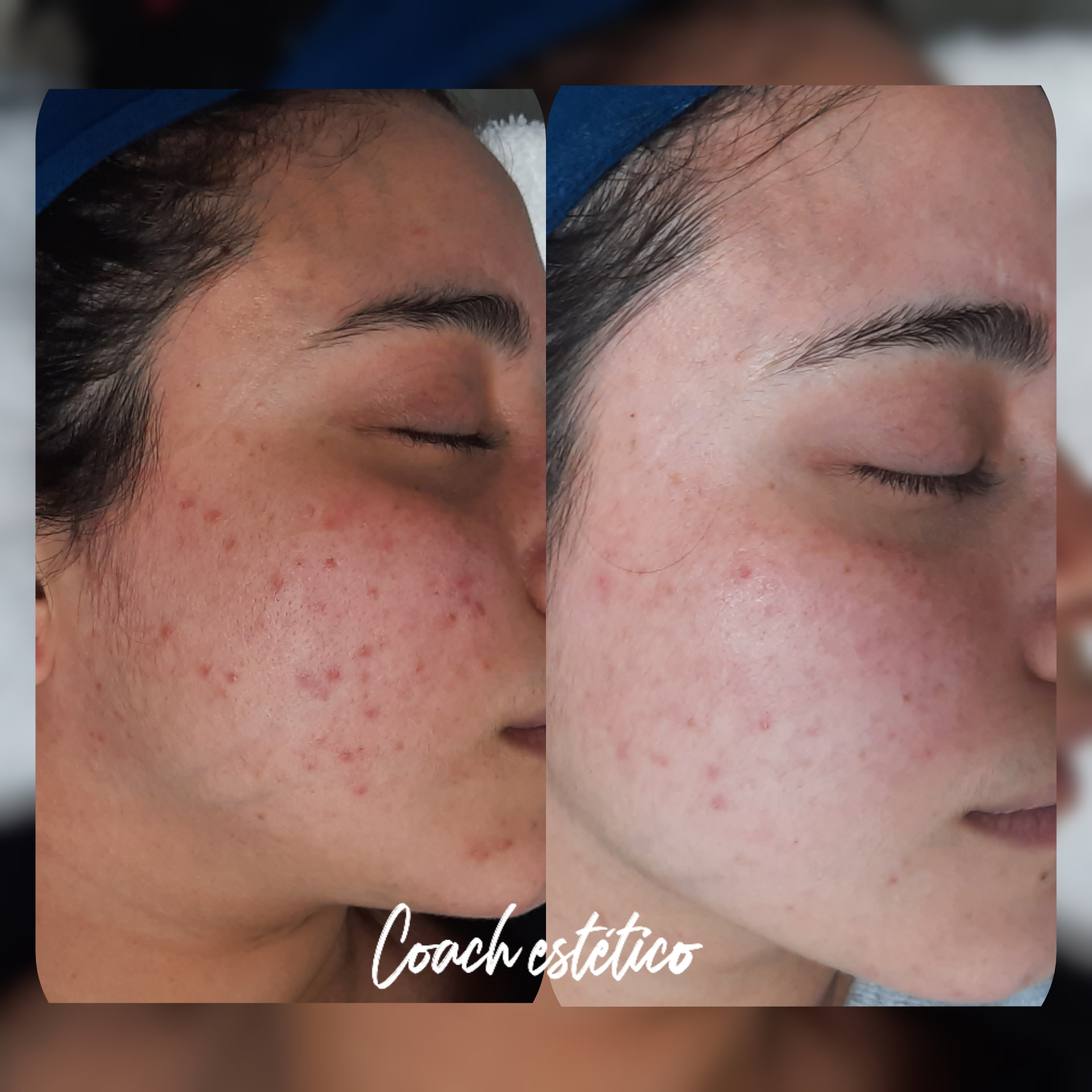 Antes y después: Reestructuración de piel con acné activo