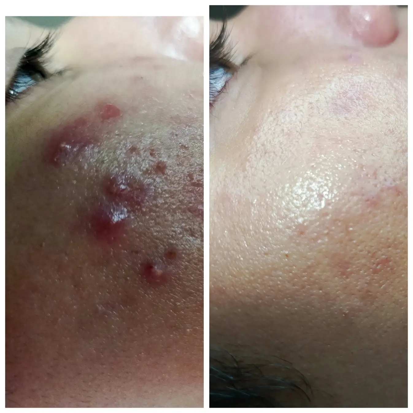 Antes y después: Lesiones inflamatorias y cicatrices