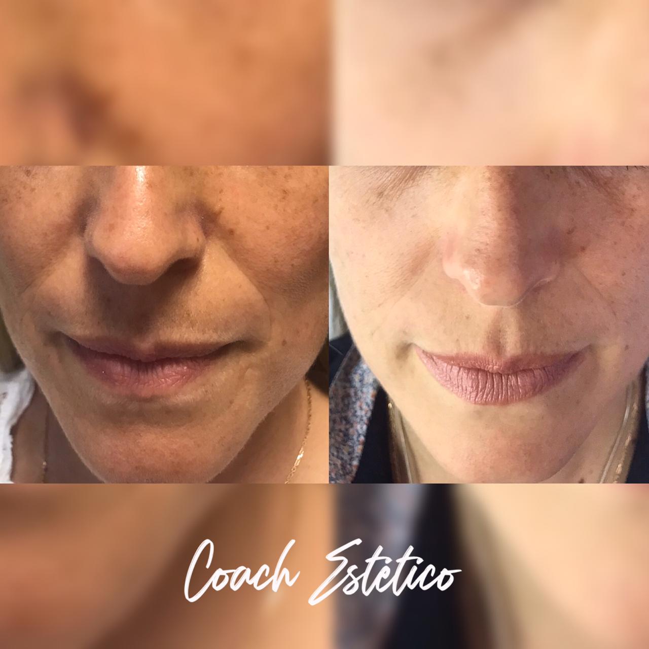 Antes y después: Rejuvenecimiento full face con Dermapen