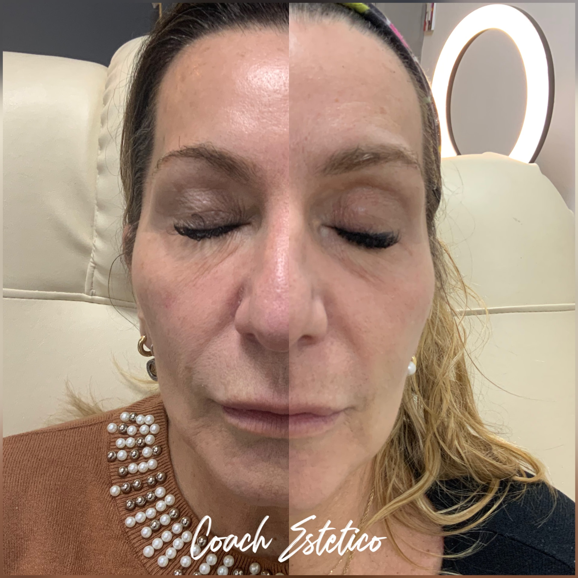 Antes y después: Contorno de ojos con Dermapen